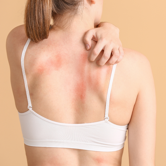 donna che si gratta - dermatite da contatto stress